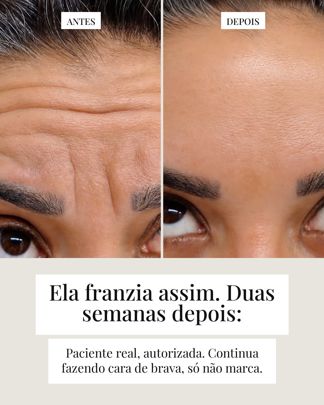Cinco mentiras sobre botox — card 7