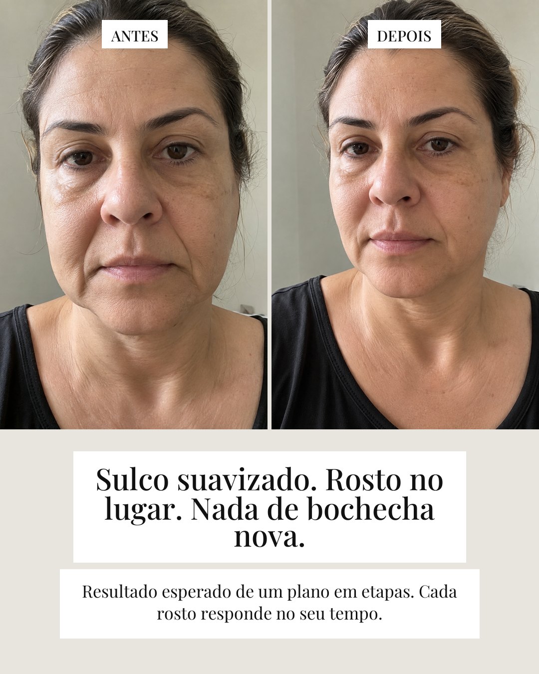 Harmonização que ninguém percebe — card 7